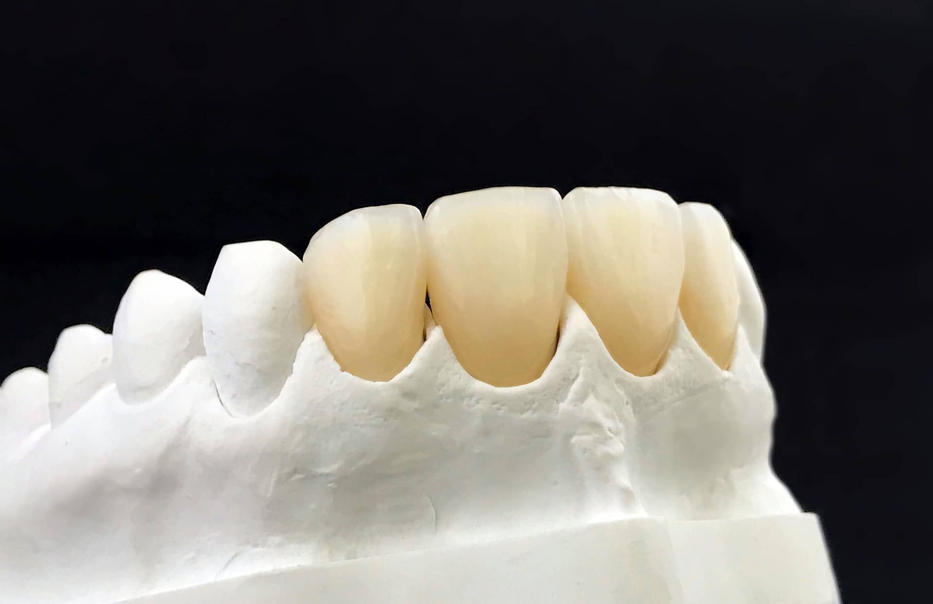 dental-zirconia-crowns-in-the-plaster-model-white-2025-02-03-00-57-46-utc 1