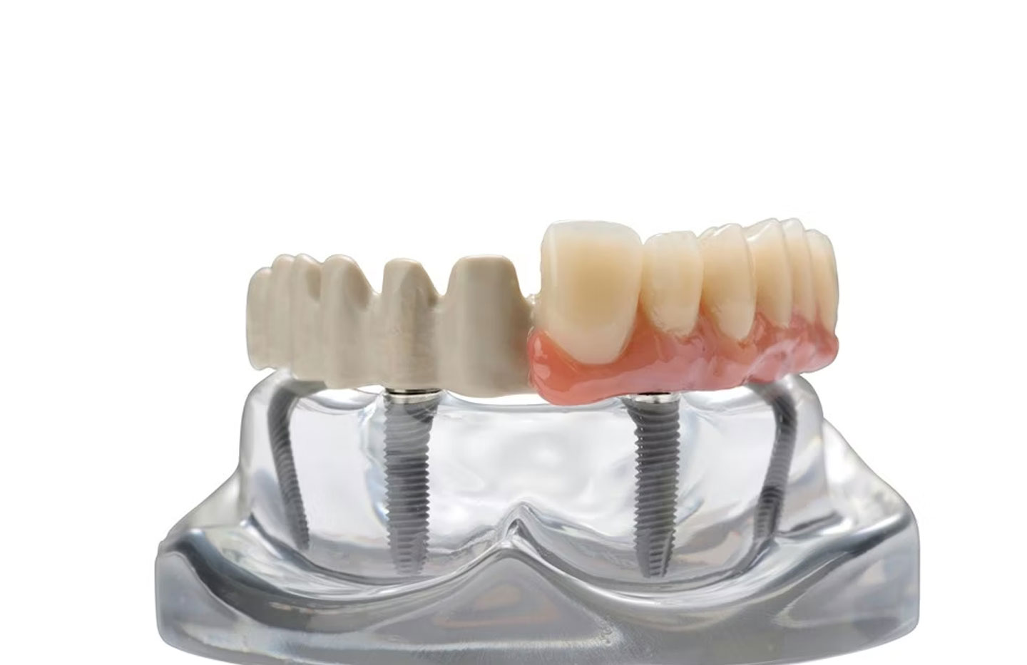 PEEK Dental