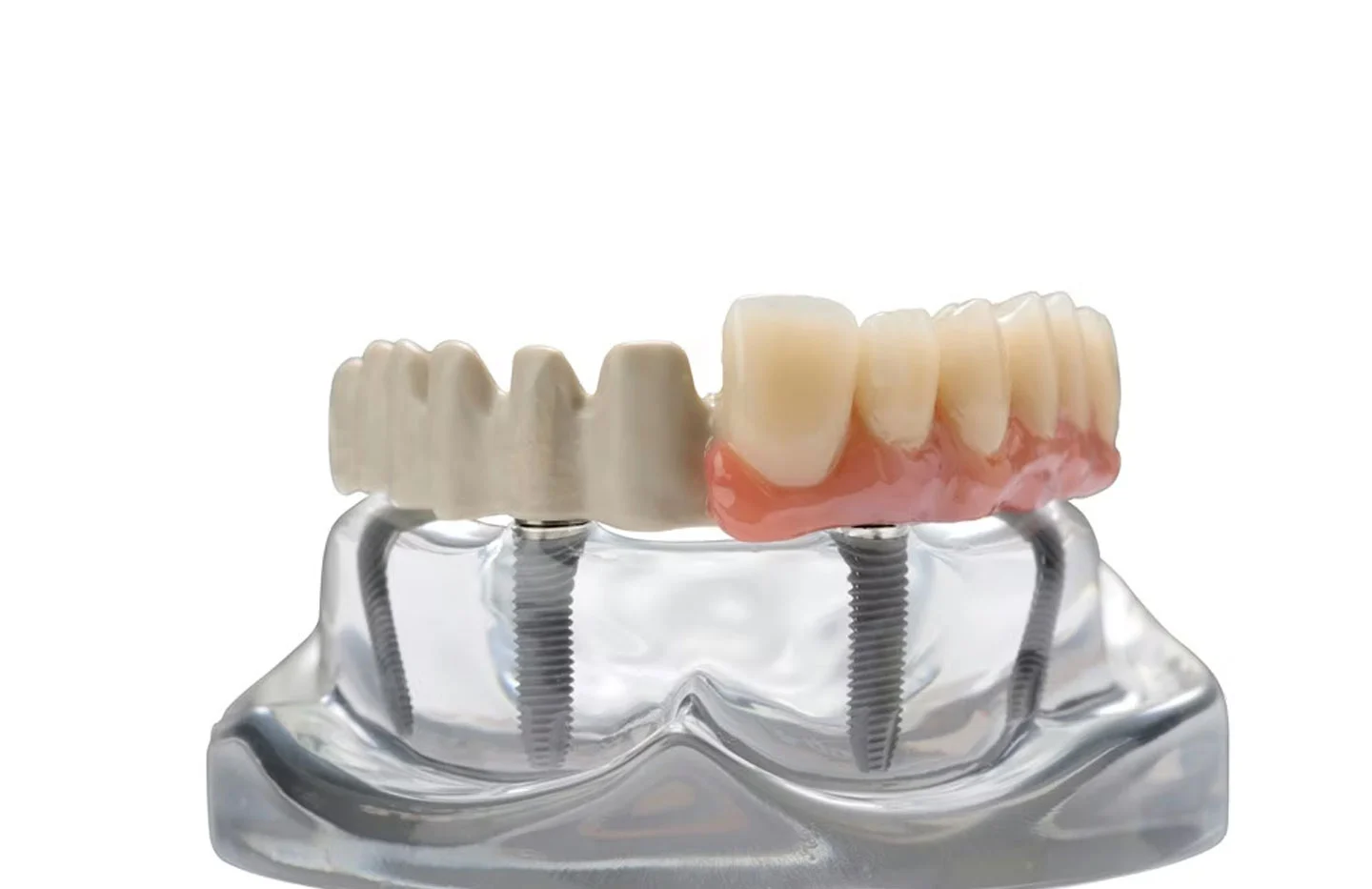 PEEK Dental